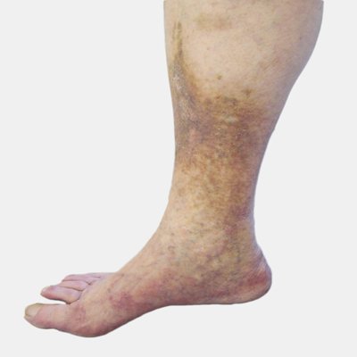Reticular